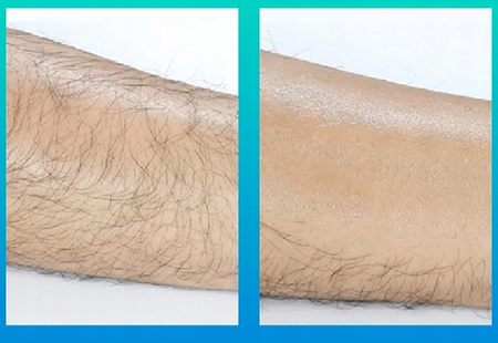 NANOKRYSTALICZNY DEPILATOR do ciała bezbolesny do usuwania włosków ręczny